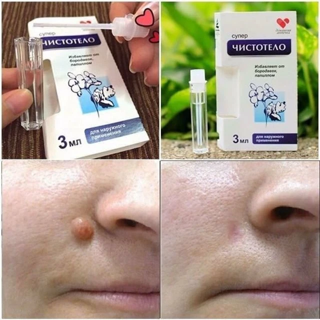 Gel Tẩy Nốt Ruồi - Mụn Cóc - Mụn Thịt - Sẹo Lồi Nga Chính Hãng - ảnh 2