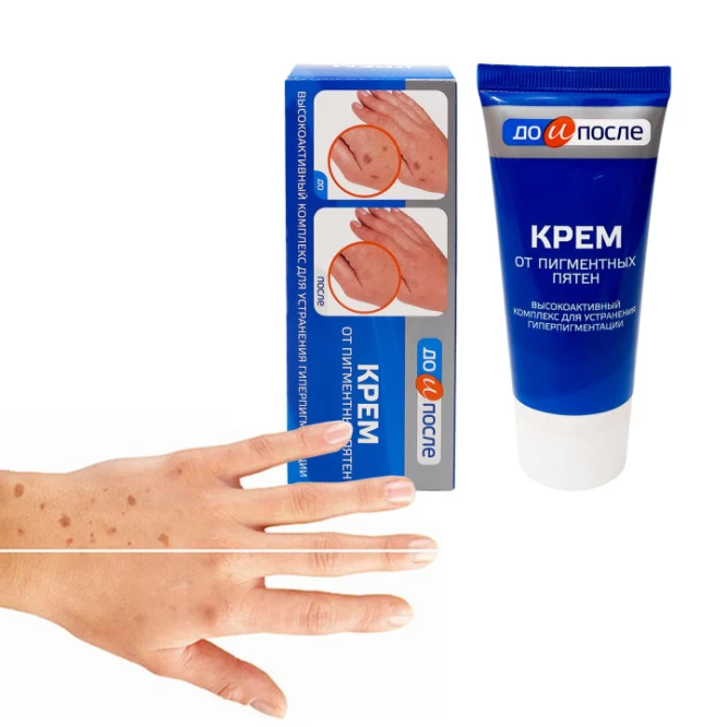 Kem Tay Kpem Trị Đồi Mồi , Vết Nám , Sạm Đốm Nâu Da Tay 50ml - ảnh 1