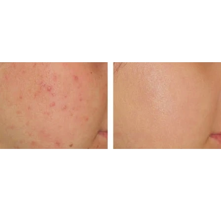 Kem Trị Mụn Yanhee Acne Cream 10g Thái Lan - ảnh 2