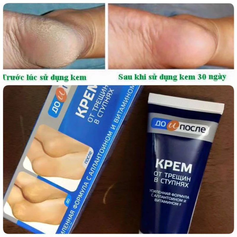 Kem Trị Nứt Gót Chân Kpem Chính Hãng Nga - ảnh 2
