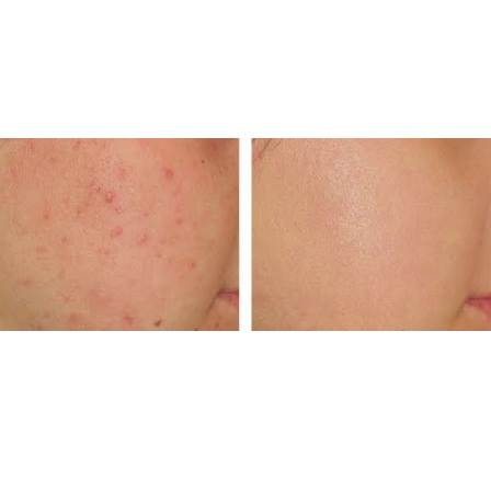 Kem Trị Mụn Yanhee Acne Cream 10g Thái Lan-1