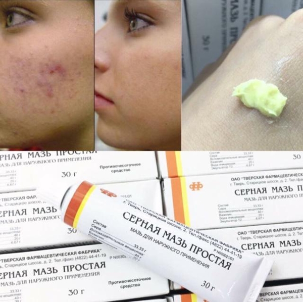 Thuốc Mỡ Lưu Huỳnh Chuyên Trị Mụn Viêm - Mụn Đỏ - Sưng Tấy Chính Hãng Nga-1