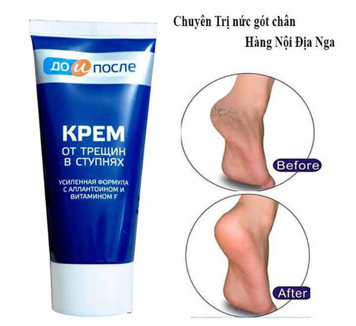 Kem Trị Nứt Gót Chân Kpem Chính Hãng Nga Chăm Sóc Cá Nhân-1