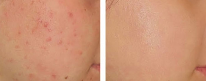 Kem Trị Mụn Yanhee Acne Cream 10g Thái Lan Dưỡng Da Mặt-1