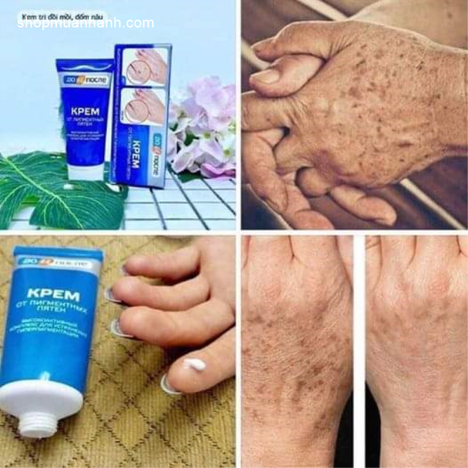 Kem Tay Kpem Trị Đồi Mồi , Vết Nám , Sạm Đốm Nâu Da Tay 50ml Dưỡng Da Mặt-1