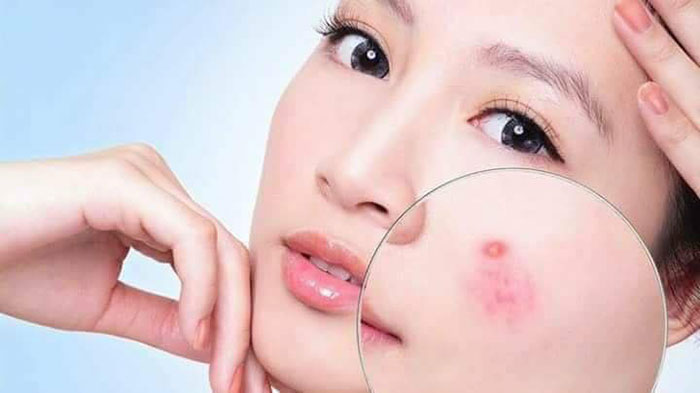 Kem Trị Mụn Trứng Cá Azeloin Và Zinc Chính Hãng Dưỡng Da Mặt-1