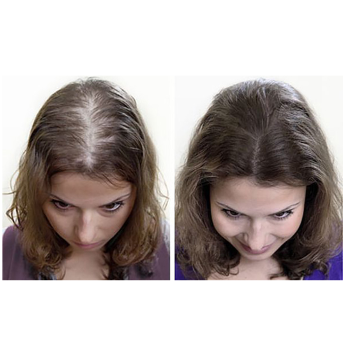 Xịt Kích Mọc Tóc - Trị Hói Của Nga-2